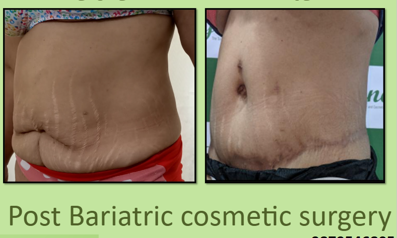 Hanging Stomach After Weight Loss in Surat