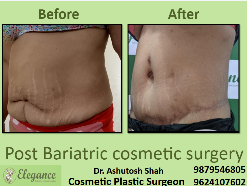 Hanging Stomach After Weight Loss in Surat
