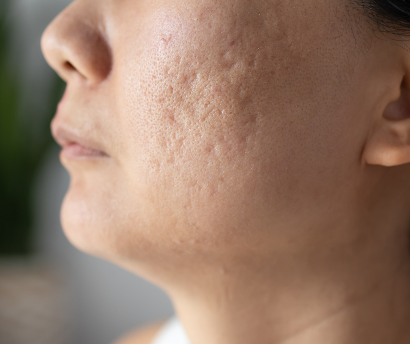 Acne scars - pitted skin and dark marks left behind by old pimples on the face