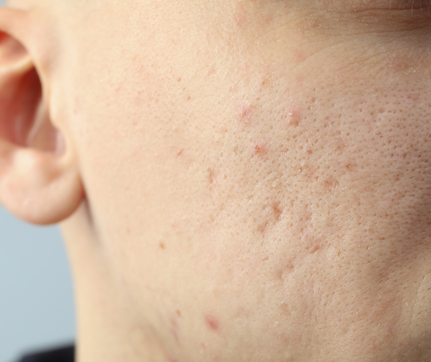 Acne vulgaris - red inflamed pimples and breakouts on facial skin, common dermatology condition