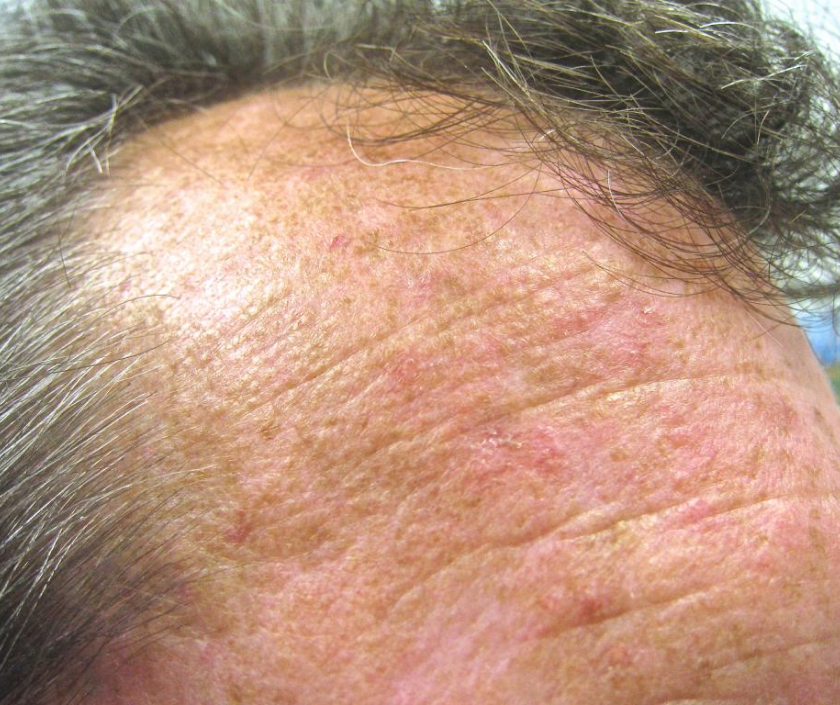 Actinic keratosis - rough scaly pre-cancerous patches caused by chronic sun damage