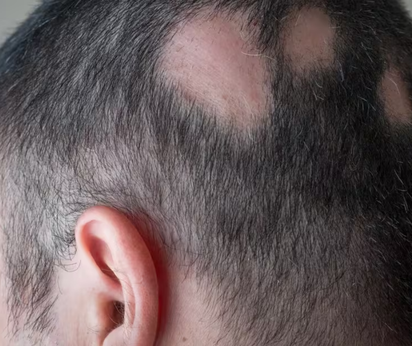 Alopecia areata - smooth round patchy hair loss on the scalp, autoimmune condition