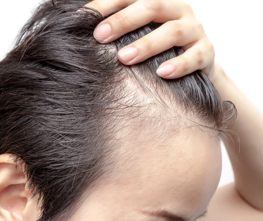 Androgenetic alopecia - male and female pattern baldness with thinning hairline
