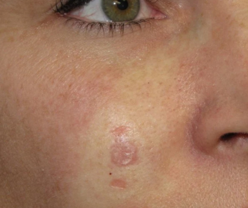 Basal cell carcinoma - slow-growing pearly skin cancer lesion on sun-exposed skin
