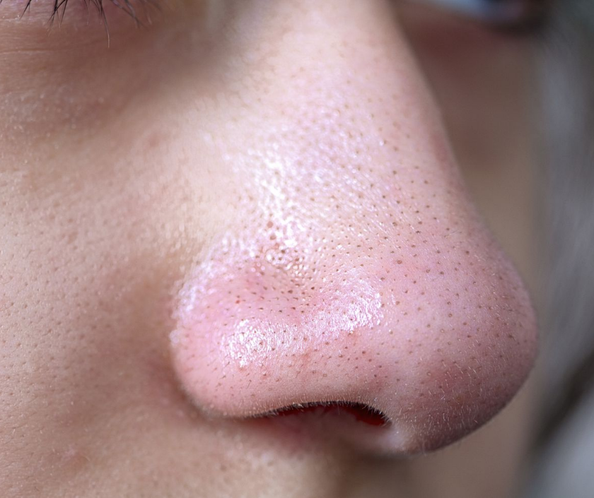 Blackheads on nose and face - open clogged pores with dark oxidized debris (open comedones)