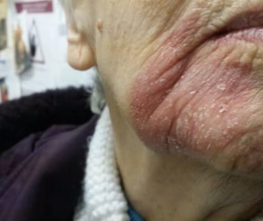 Bowen’s disease - red scaly patch of very early squamous cell skin cancer