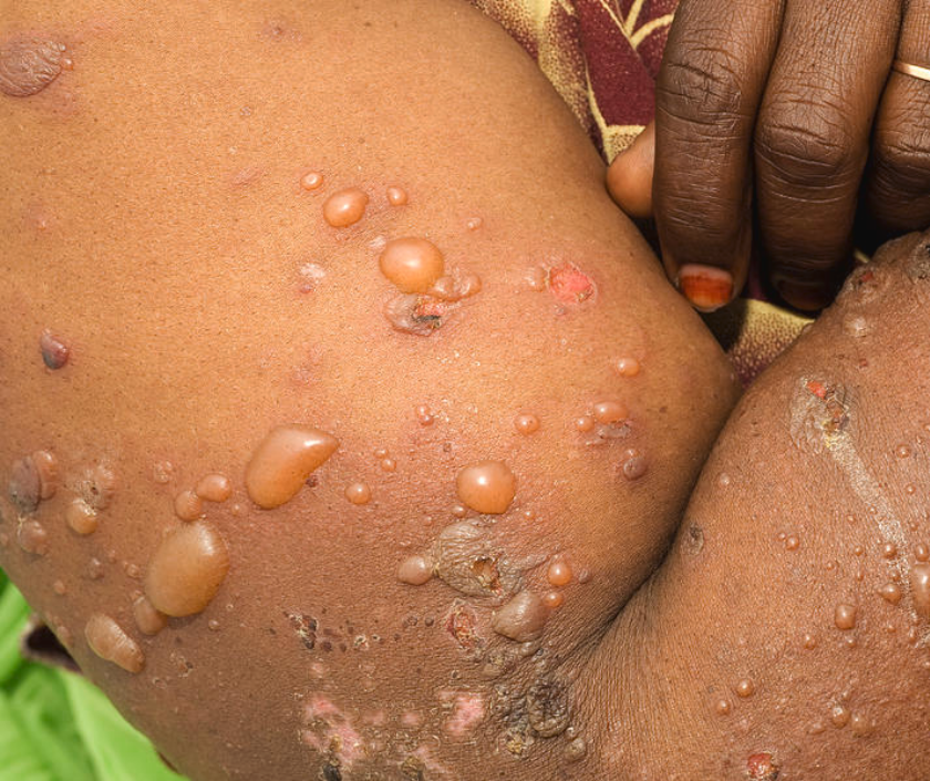 Bullous pemphigoid - tense large autoimmune blisters of the skin most common in older adults