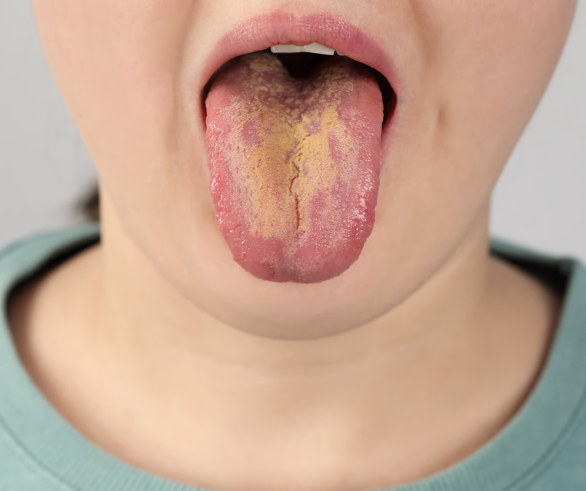 Candidiasis - red itchy yeast skin infection commonly in warm moist skin folds
