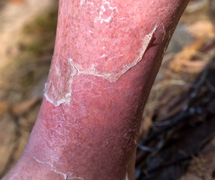 Cellulitis - deep red swollen tender bacterial skin infection on the lower leg