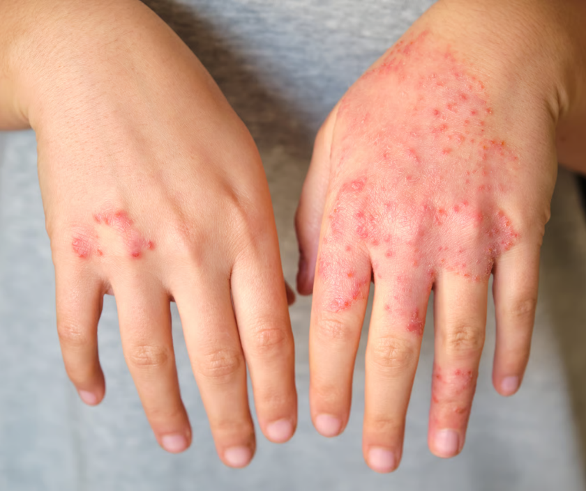 Contact dermatitis - red itchy allergic rash from contact with irritants or allergens