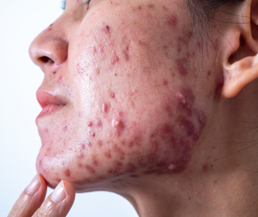 Cystic acne - deep painful nodular lesions under the skin needing medical dermatology treatment