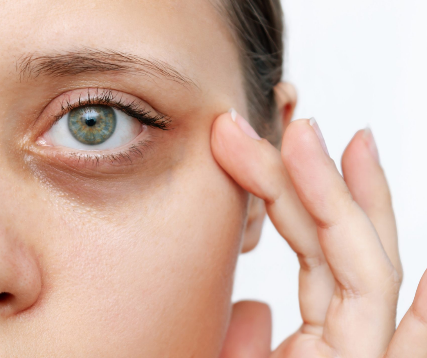 Dark circles under the eyes - pigmented under-eye area giving a tired sunken appearance