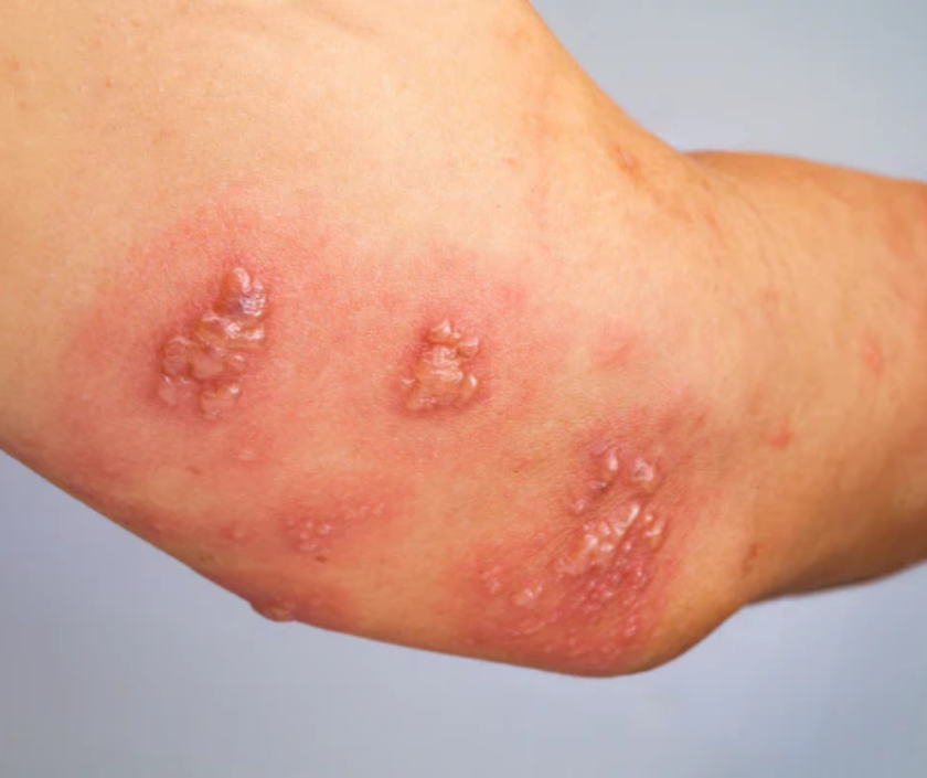 Dermatitis herpetiformis - intensely itchy clustered blisters linked to celiac disease