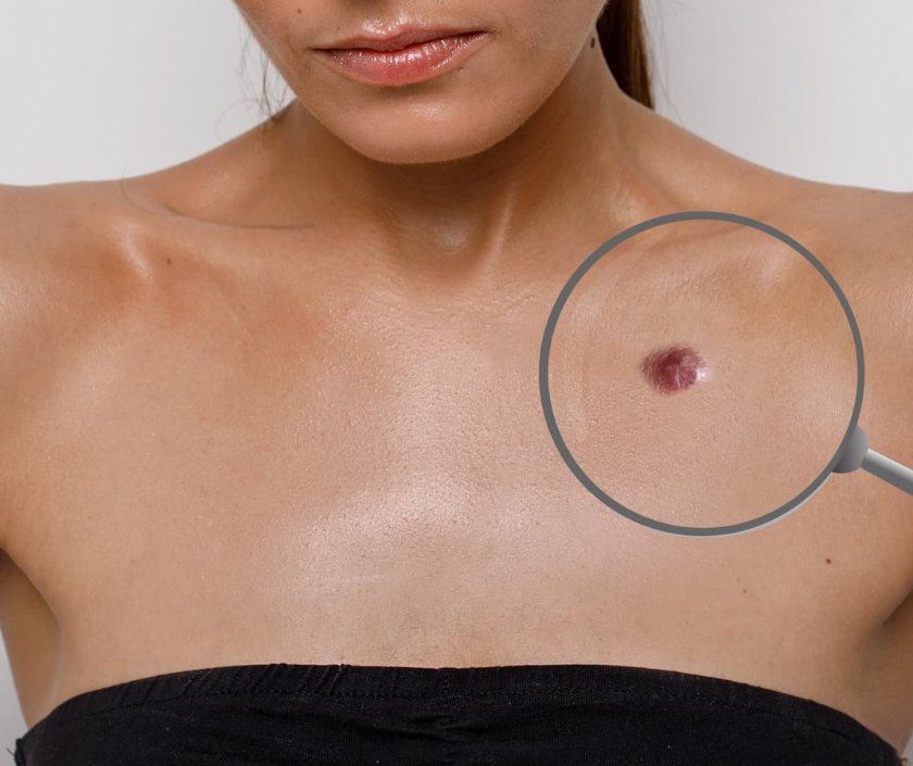 Dermatofibroma - hard pinch-puckering firm benign skin lump usually on the legs