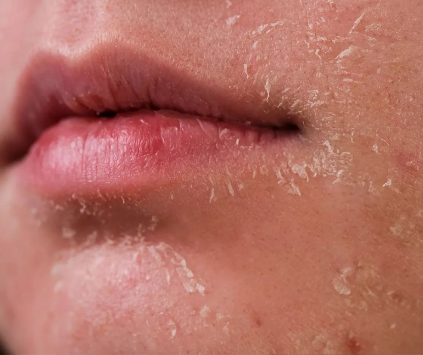 Dry skin - rough flaky patches with low moisture and tightness, common skin condition