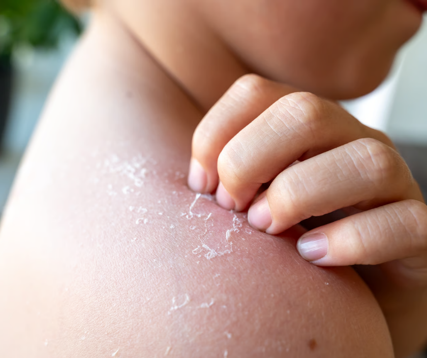 Eczema - itchy red dry inflamed rash patches, chronic skin condition (atopic dermatitis)