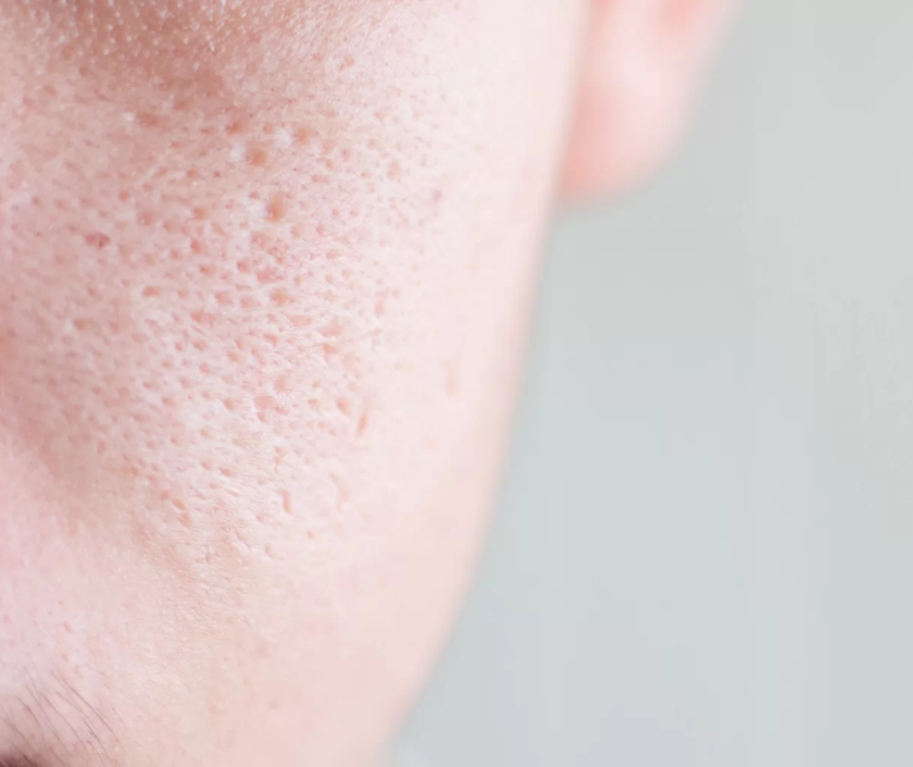 Enlarged pores - visibly open and dilated pores on the cheeks and nose, dermatology concern