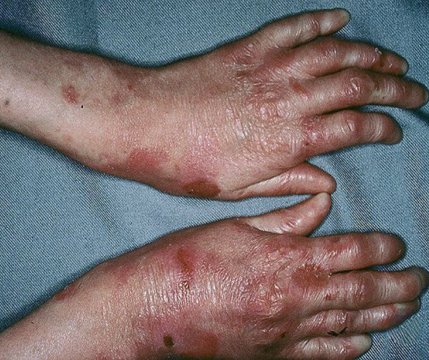 Epidermolysis bullosa - genetic fragile-skin disease with blisters from minor friction