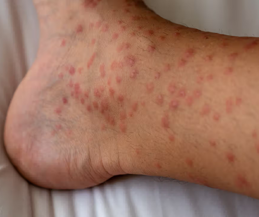 Erythema multiforme - target-shaped concentric red lesions of hypersensitivity rash