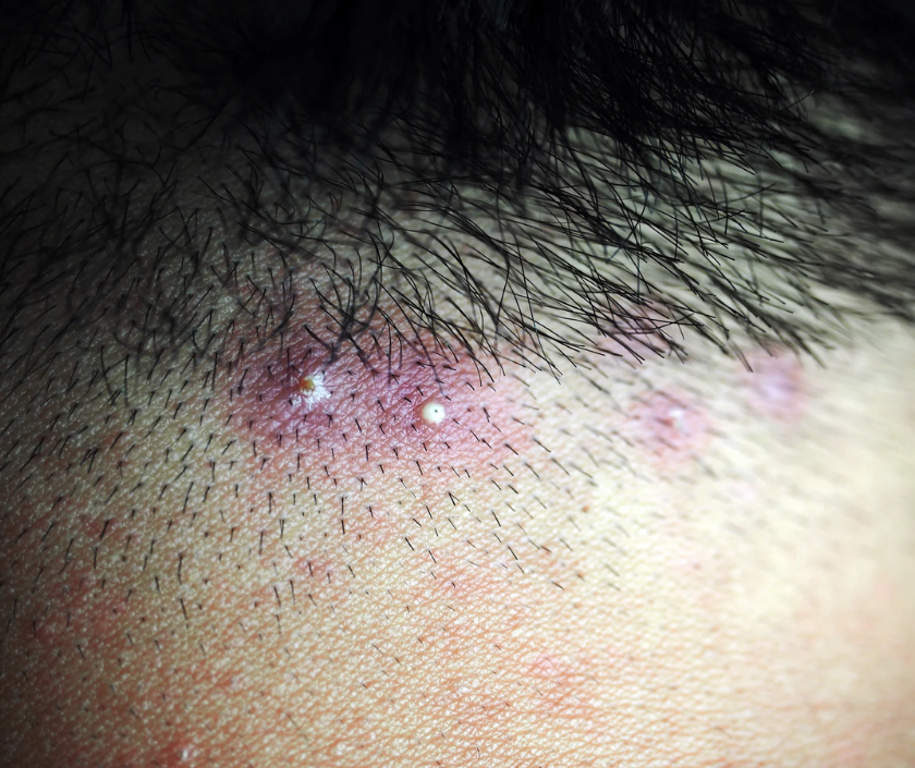 Folliculitis - small red infected bumps around hair follicles on the skin
