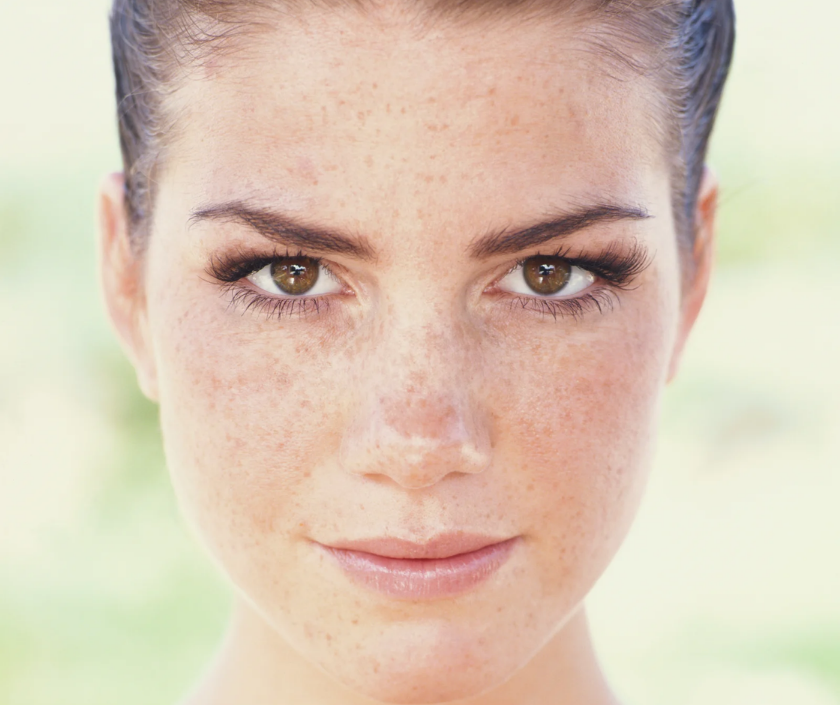 Freckles and lentigines - small flat brown sun spots and freckles on sun-exposed skin