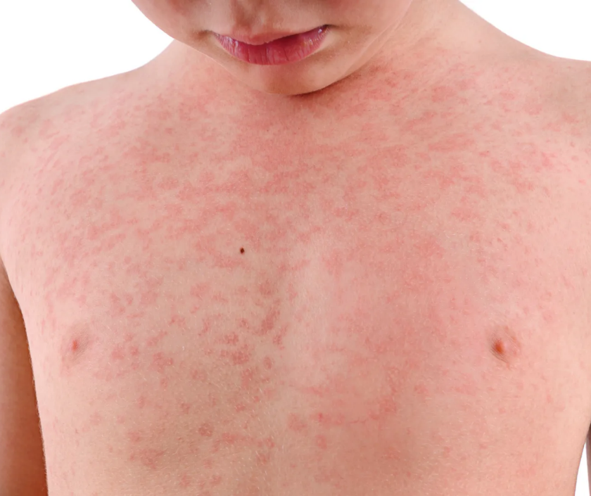 Heat rash and prickly heat - itchy red bumps caused by blocked sweat ducts on the skin