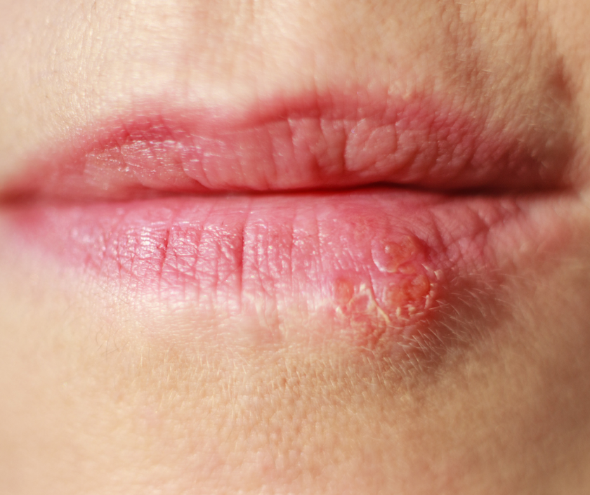 Herpes simplex - painful cold sore blisters around the lips and mouth area