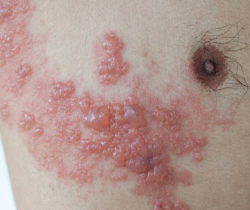 Herpes zoster or shingles - painful blistering rash in a band along one side of the body