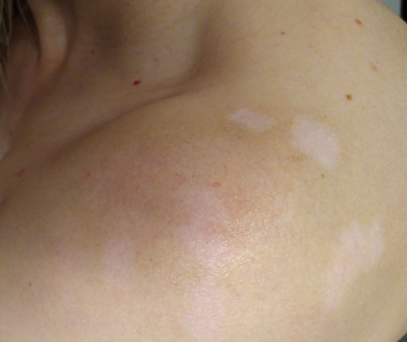 Hypopigmentation - lighter than normal skin patches with reduced melanin pigment