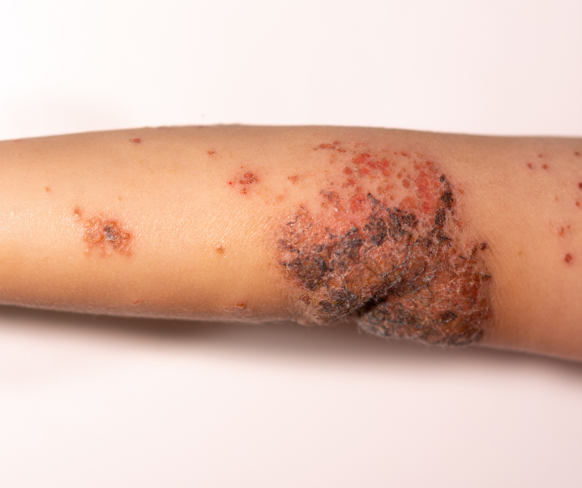 Impetigo - sticky honey-crusted bacterial skin infection commonly seen in children