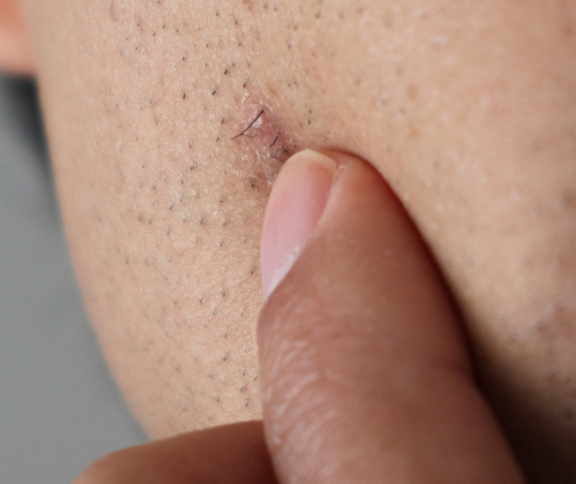 Ingrown hairs - red bumps where hair curls back and grows into the skin after shaving