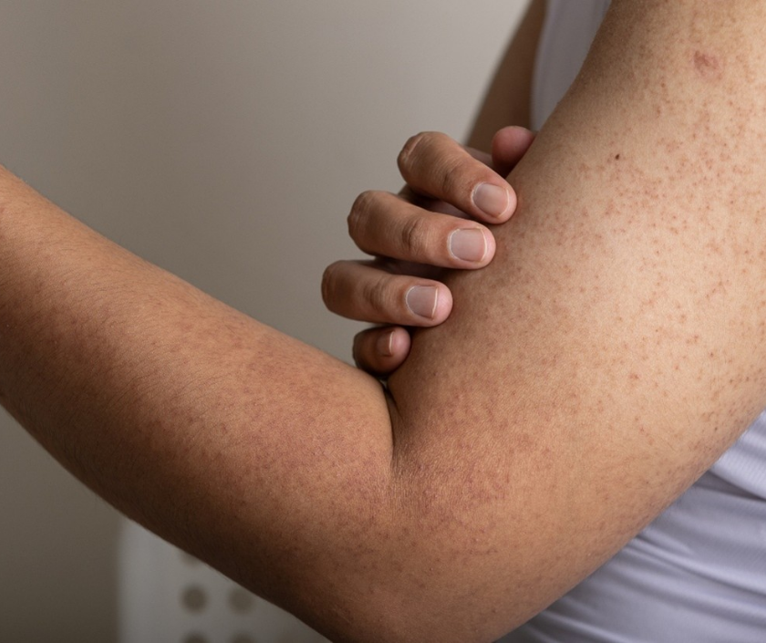 Keratosis pilaris - rough chicken-skin bumps on the upper arms and thighs