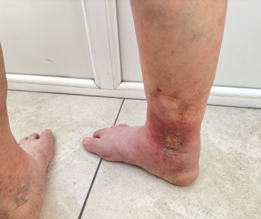 Leg ulcers - chronic non-healing wounds on lower legs from poor circulation