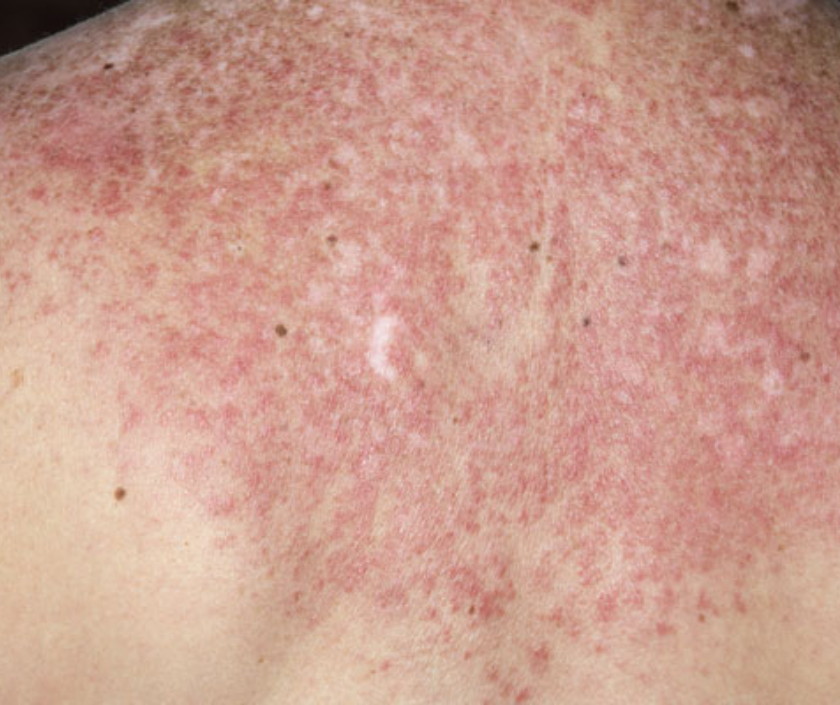 Cutaneous lupus - autoimmune butterfly facial rash and discoid skin lesions