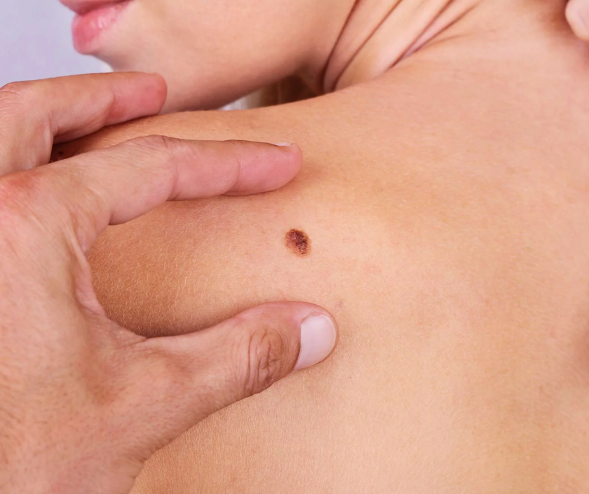 Melanoma - dark irregular mole or skin lesion, the most serious form of skin cancer