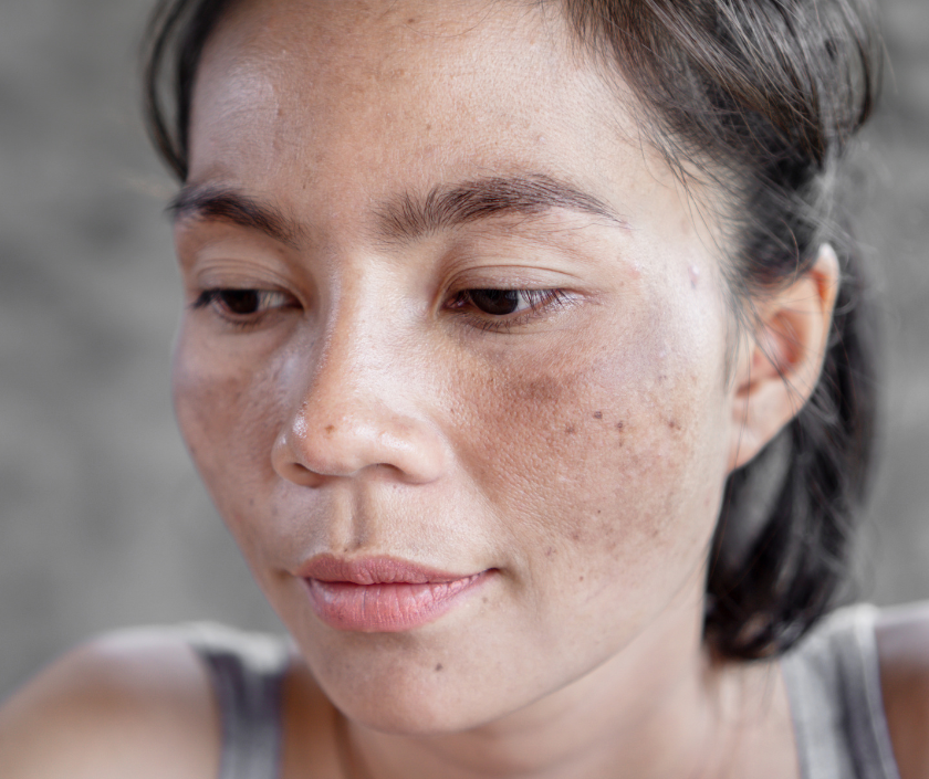 Melasma - symmetrical brown facial pigmentation patches on cheeks forehead and upper lip