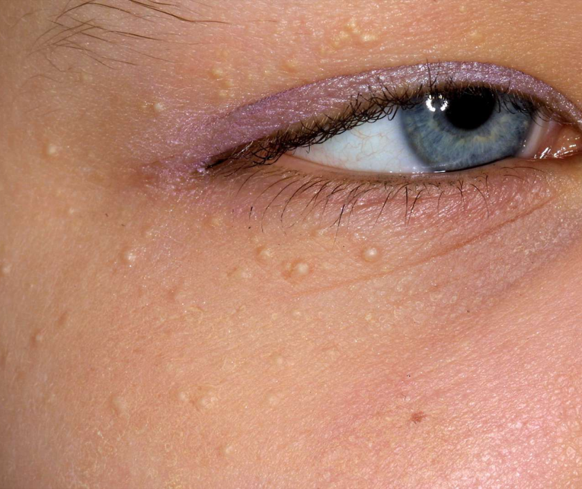 Milia - tiny white keratin-filled bumps under the surface of the skin around the eyes