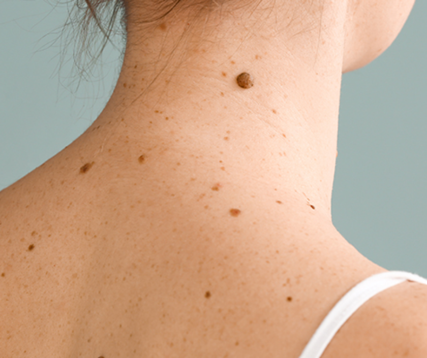 Moles - normal pigmented brown skin spots (melanocytic nevi) usually harmless