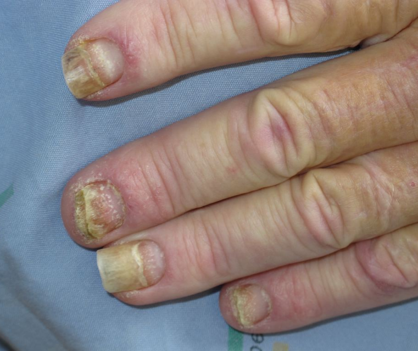 Nail psoriasis - pitted ridged discolored nails caused by underlying psoriasis