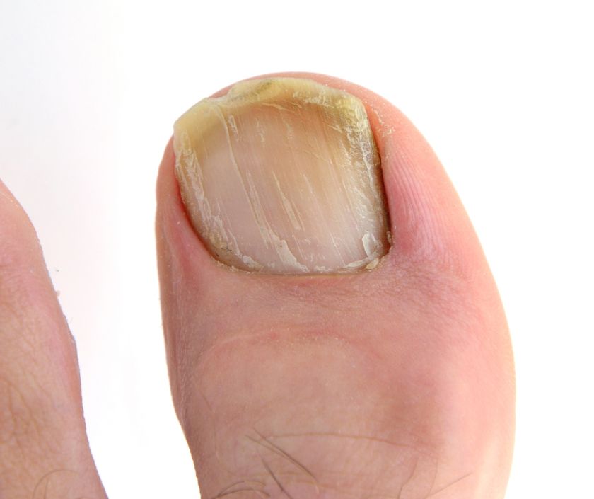 Onychomycosis - thick discolored fungal nail infection of toenails and fingernails