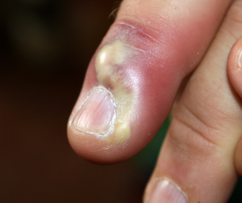 Paronychia - painful red swollen nail-fold infection around the fingernail edge