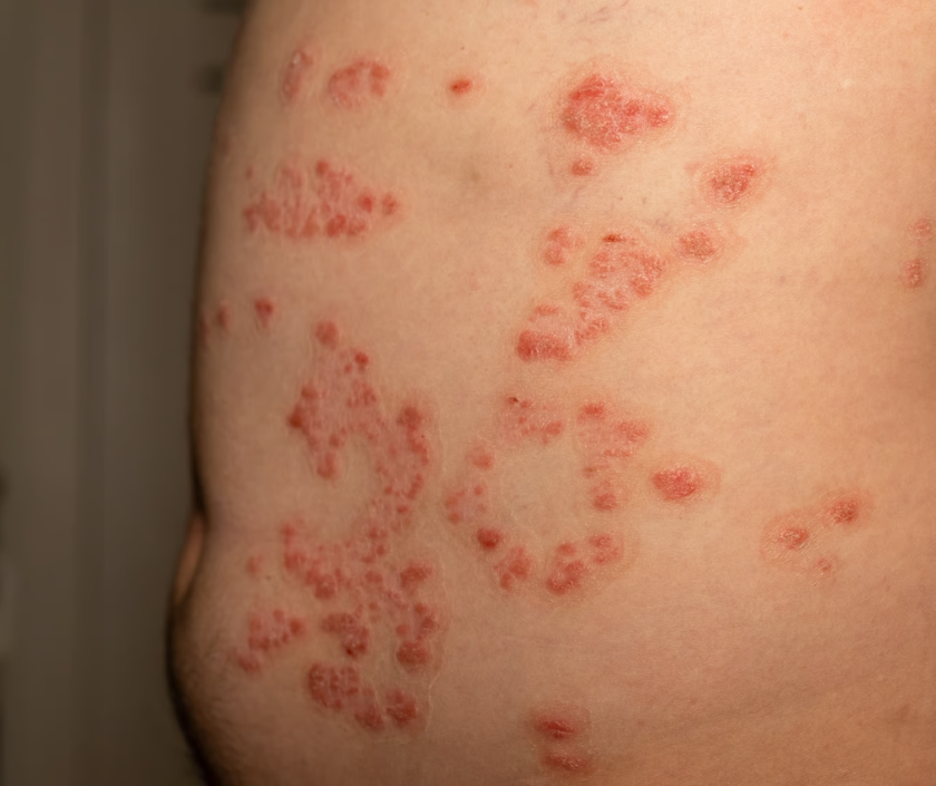 Pemphigus vulgaris - severe autoimmune blistering disease of skin and mucous membranes