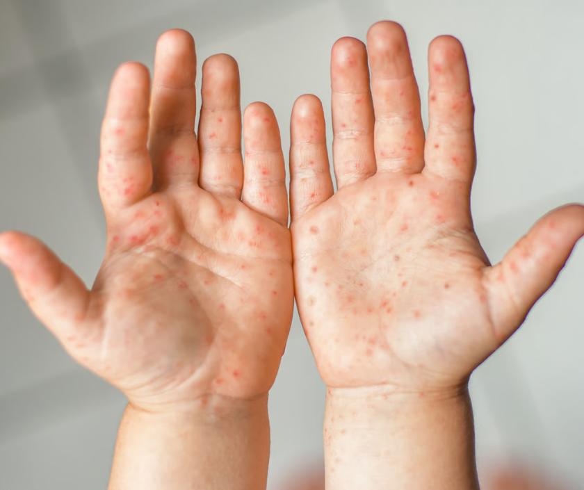 Pompholyx - itchy blister eczema on the hands and feet with deep clear vesicles
