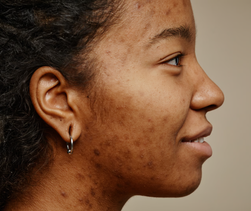 Post-inflammatory hyperpigmentation - dark brown spots and marks left after acne or injury