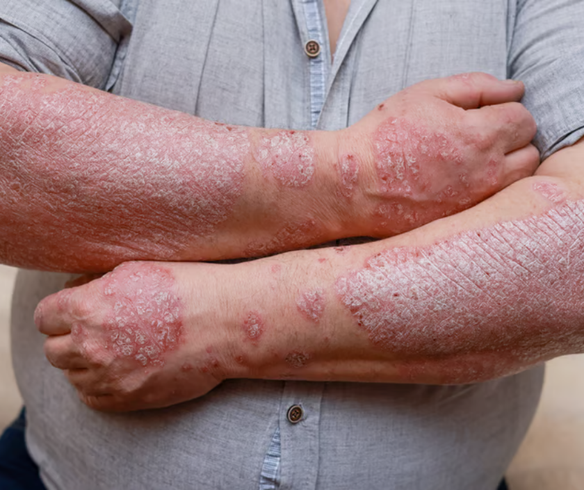 Psoriasis - thick silvery scaly patches of inflamed skin, chronic autoimmune condition