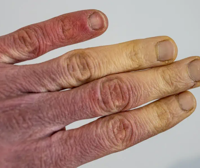 Raynaud’s phenomenon - cold-triggered finger color change from white to blue to red