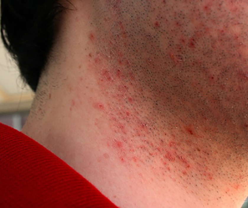 Razor bumps (pseudofolliculitis barbae) - inflamed shaving bumps on the beard and neck