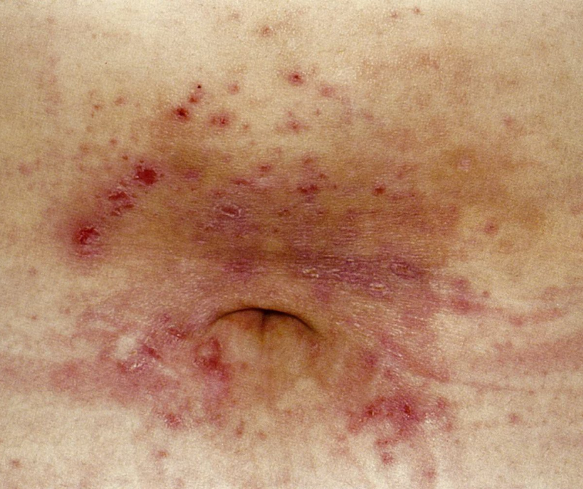 Scabies - intensely itchy mite infection with burrow lines on hands and between fingers