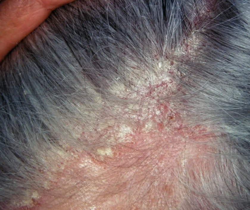 Seborrheic dermatitis - flaky greasy rash on scalp and face, dandruff-like skin condition