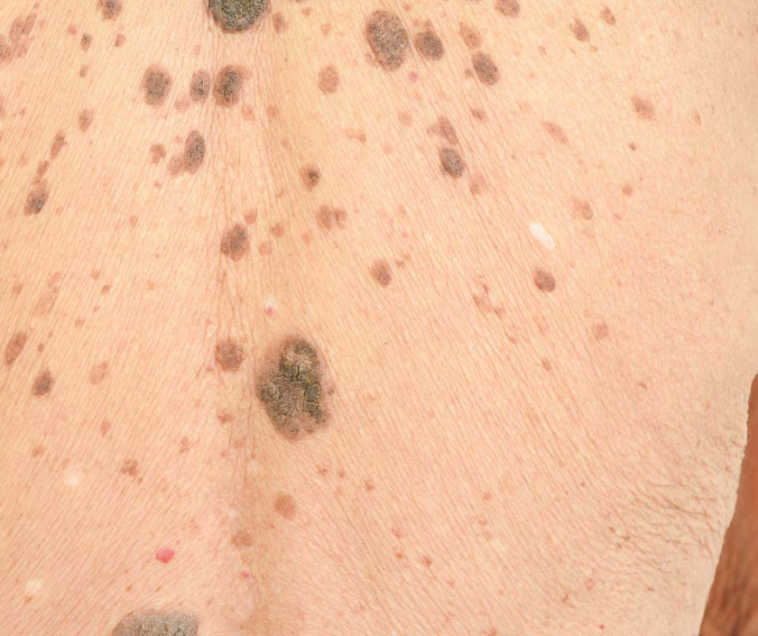 Seborrhoeic keratosis - harmless warty stuck-on brown growths common with age